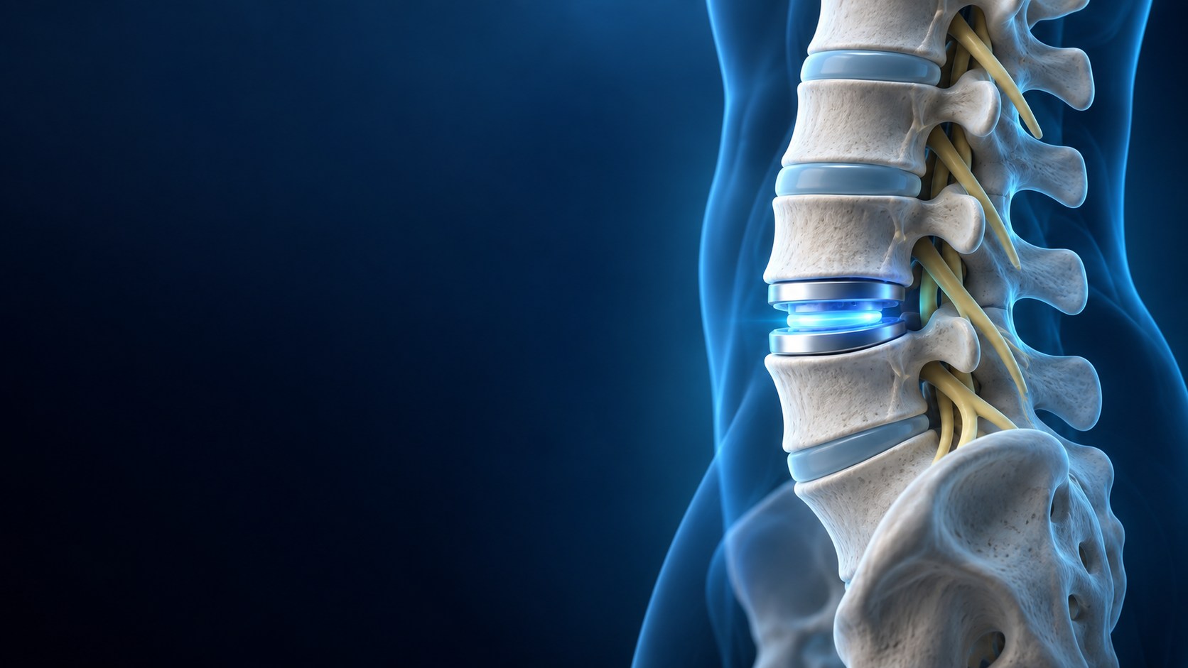 Artificial disc replacement anatomy illustration