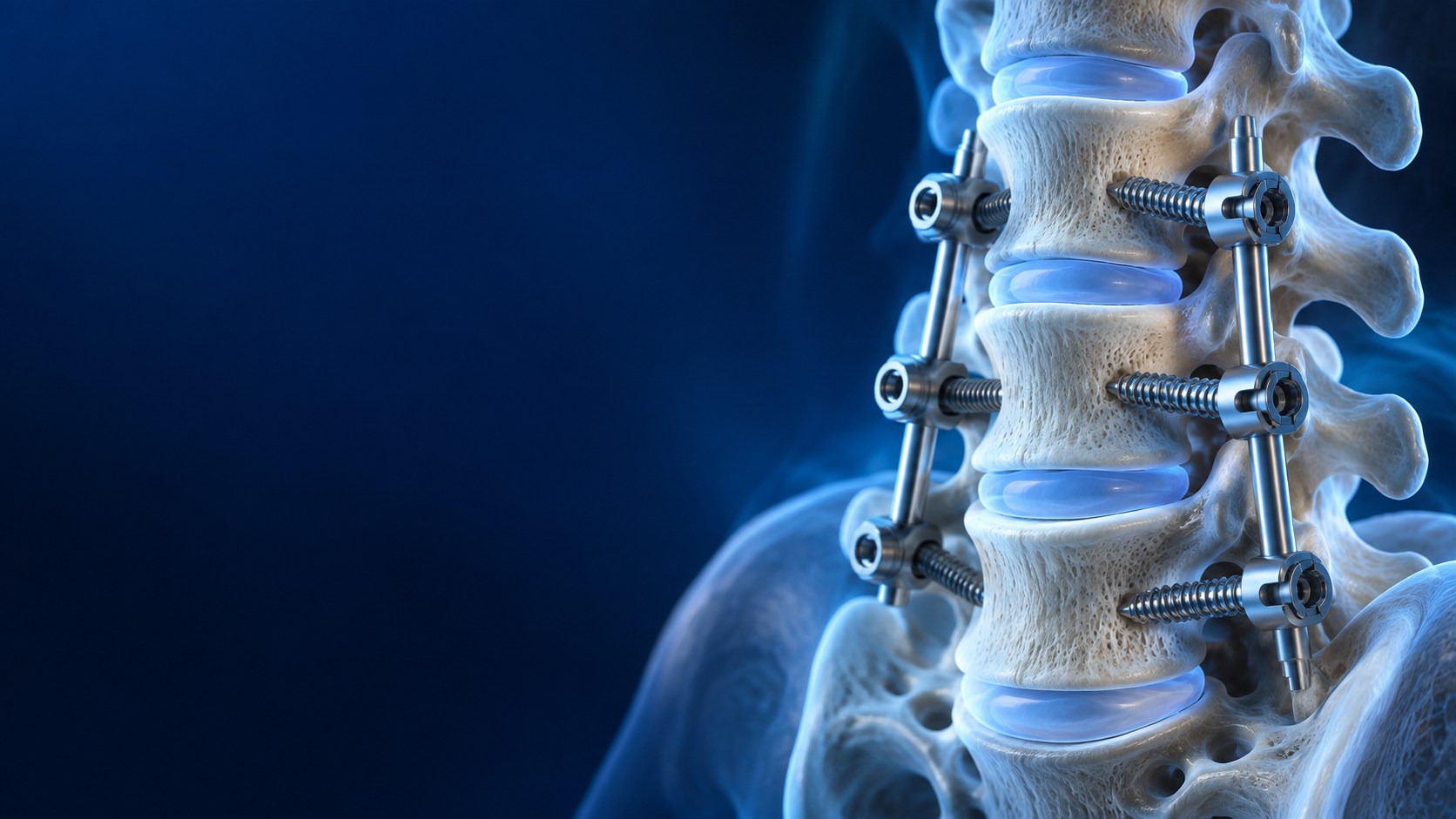 Spinal stabilisation surgery illustration
